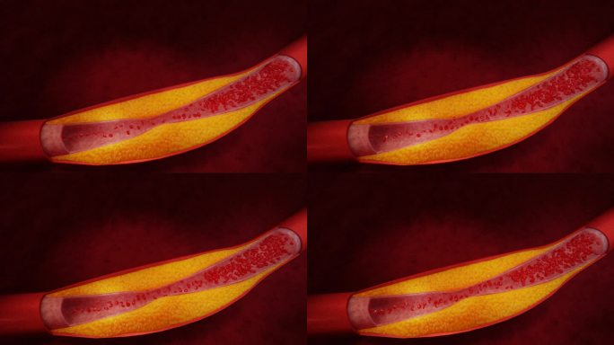 高脂血症。动脉阻塞的概念和人体血管作为一种疾病与胆固醇脂肪堆积堵塞。动脉阻塞，动脉中的胆固醇斑块。三