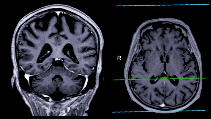 带参考线的MRI大脑可以帮助医生寻找出血、肿胀、肿瘤、感染、炎症、损伤或中风等疾病。