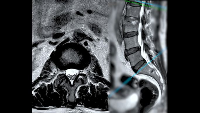 脊柱或腰椎MRI L-S诊断脊髓压迫。