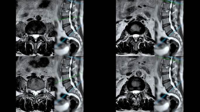 脊柱或腰椎MRI L-S诊断脊髓压迫。