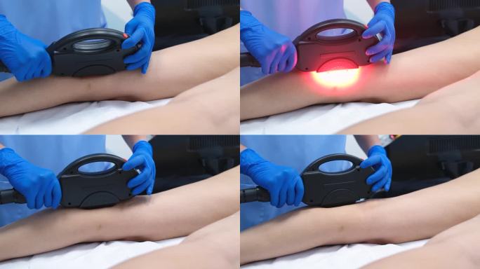 整形外科医生在女人的腿上使用激光设备