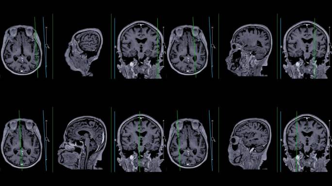 带参考线的MRI大脑可以帮助医生寻找出血、肿胀、肿瘤、感染、炎症、损伤或中风等疾病。