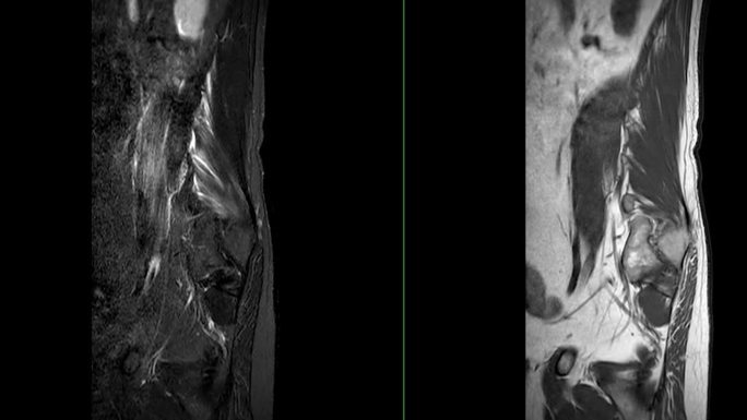 脊柱或腰椎MRI L-S诊断脊髓压迫。