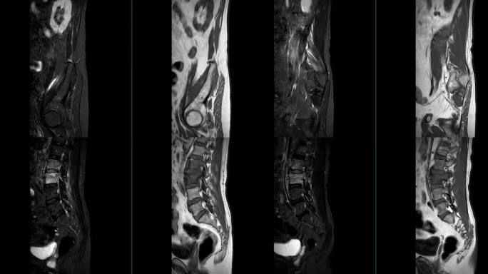 脊柱或腰椎MRI L-S诊断脊髓压迫。