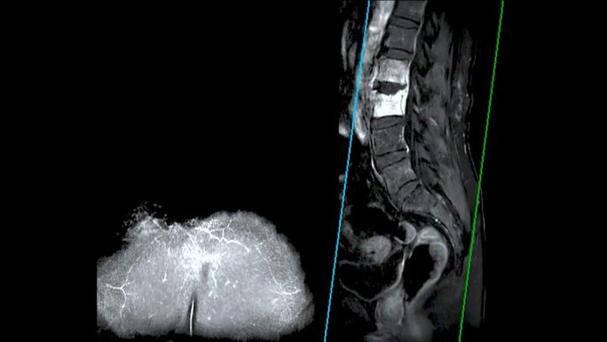 脊柱或腰椎MRI L-S显示脊柱结核。