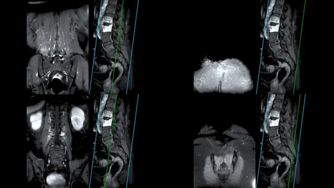 脊柱或腰椎MRI L-S显示脊柱结核。