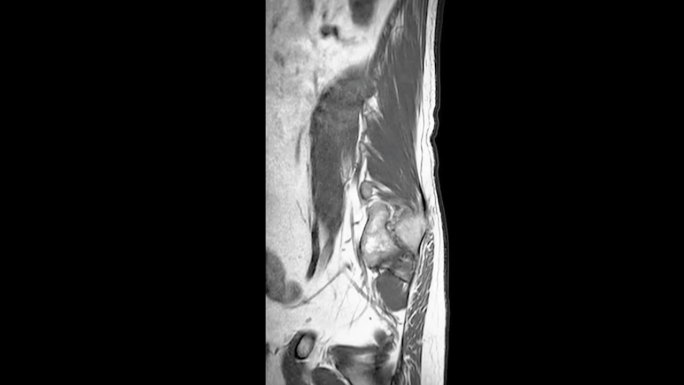 脊柱或腰椎MRI L-S诊断脊髓压迫。