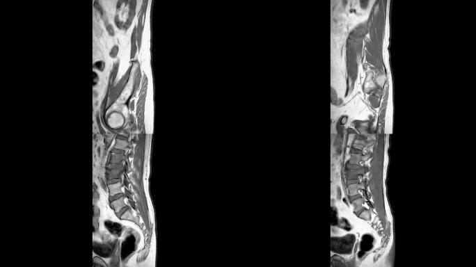 脊柱或腰椎MRI L-S诊断脊髓压迫。