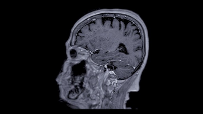 带参考线的MRI大脑可以帮助医生寻找出血、肿胀、肿瘤、感染、炎症、损伤或中风等疾病。
