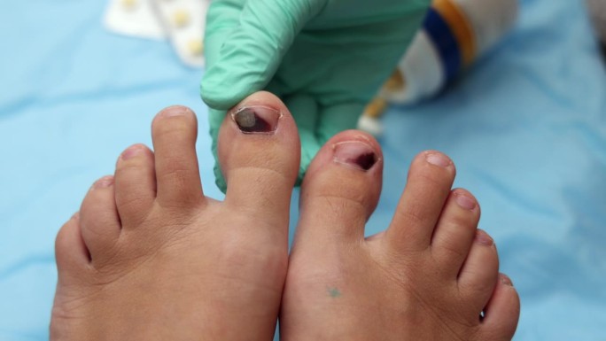 跑步者的脚趾甲上有血肿。穿不舒服的鞋或被撞的后果。