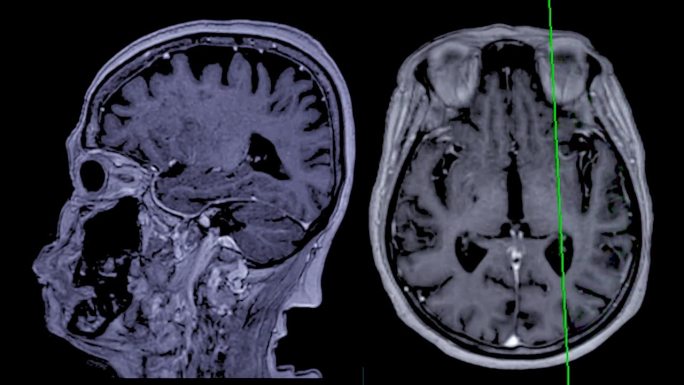 带参考线的MRI大脑可以帮助医生寻找出血、肿胀、肿瘤、感染、炎症、损伤或中风等疾病。
