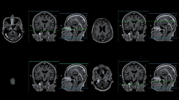 带参考线的MRI大脑可以帮助医生寻找出血、肿胀、肿瘤、感染、炎症、损伤或中风等疾病。