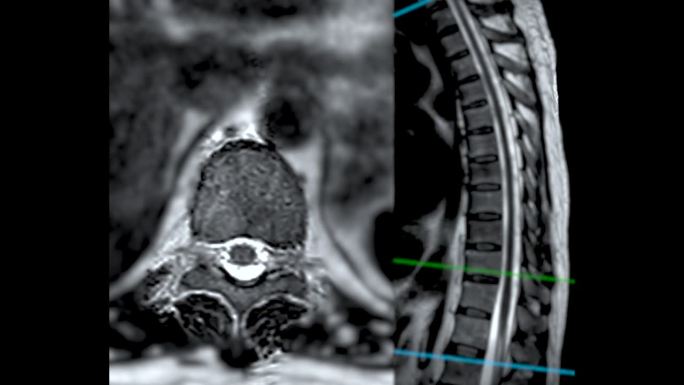 MRI T-L脊柱或胸椎冠状位和矢状位T2技术与参考线诊断脊髓压迫。