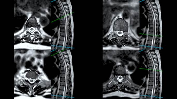 MRI T-L脊柱或胸椎冠状位和矢状位T2技术与参考线诊断脊髓压迫。