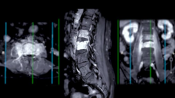 脊柱或腰椎MRI L-S显示脊柱结核。