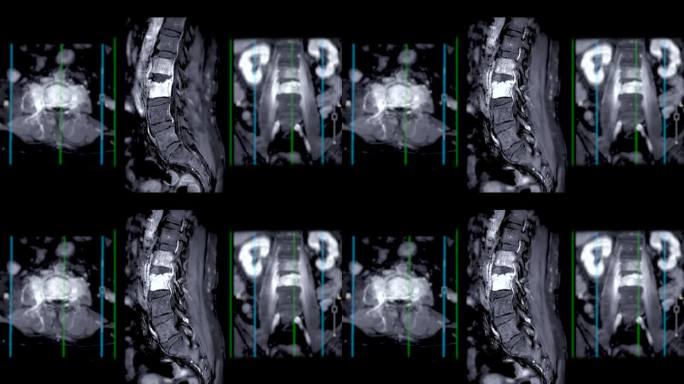 脊柱或腰椎MRI L-S显示脊柱结核。