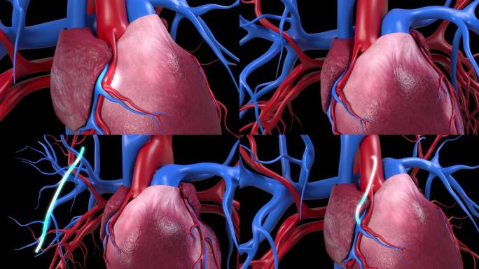 单心搭桥人体心脏心脏搭桥三维动画