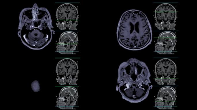 带参考线的MRI大脑可以帮助医生寻找出血、肿胀、肿瘤、感染、炎症、损伤或中风等疾病。