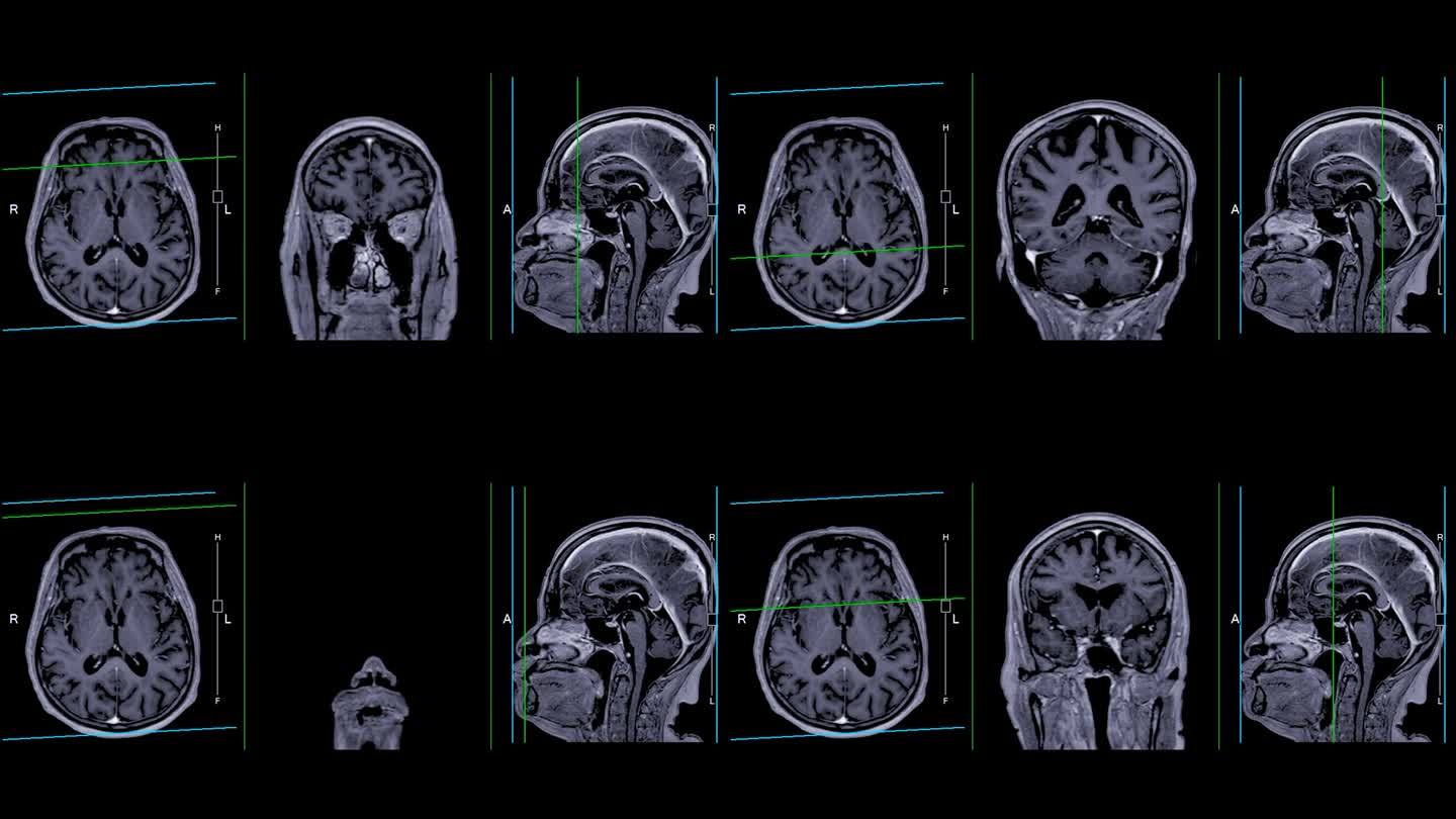 带参考线的MRI大脑可以帮助医生寻找出血、肿胀、肿瘤、感染、炎症、损伤或中风等疾病。
