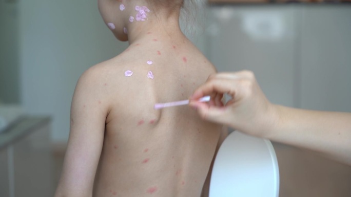 手将药膏涂抹在患水痘儿童的背部。皮疹治疗