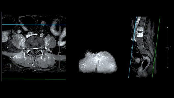 脊柱或腰椎MRI L-S显示脊柱结核。