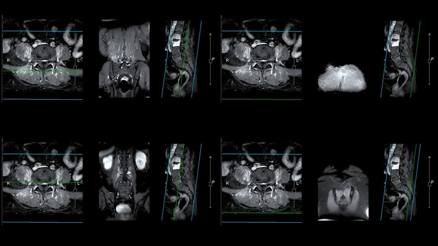 脊柱或腰椎MRI L-S显示脊柱结核。
