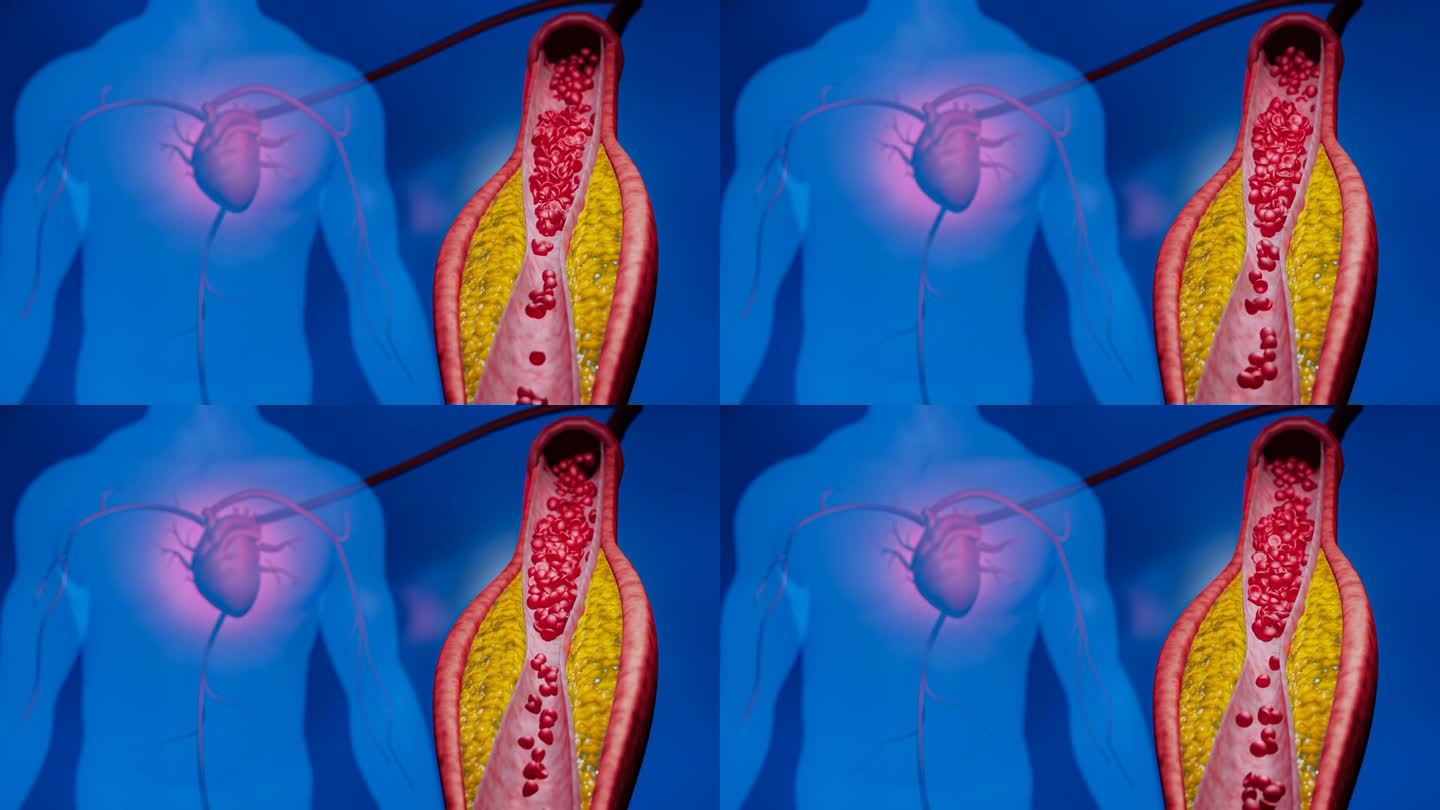 高脂血症。动脉阻塞的概念和人体血管作为一种疾病与胆固醇脂肪堆积堵塞。动脉阻塞，动脉中的胆固醇斑块。三