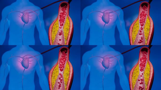 高脂血症。动脉阻塞的概念和人体血管作为一种疾病与胆固醇脂肪堆积堵塞。动脉阻塞，动脉中的胆固醇斑块。三