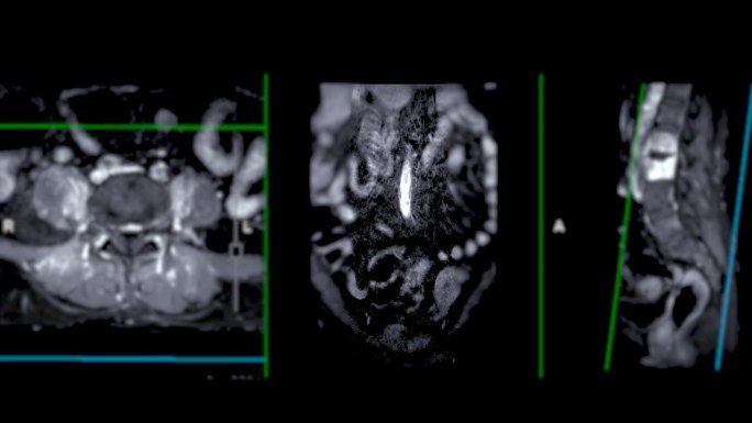 脊柱或腰椎MRI L-S显示脊柱结核。