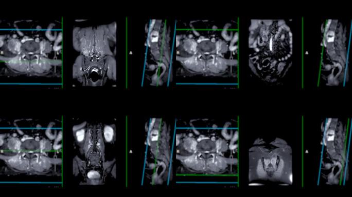 脊柱或腰椎MRI L-S显示脊柱结核。