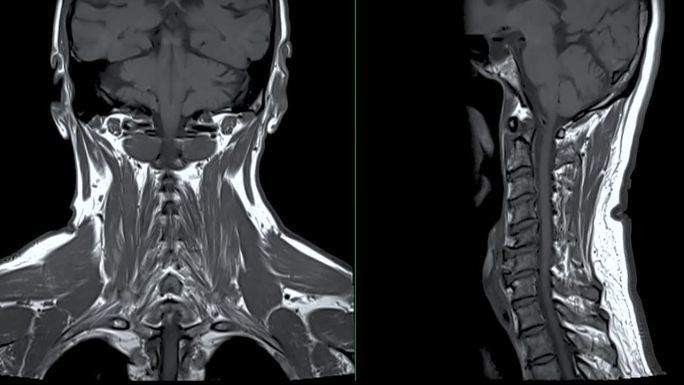 颈椎MRI或颈椎MRI冠状位和矢状位T2W片诊断颈椎病和压缩性骨折。