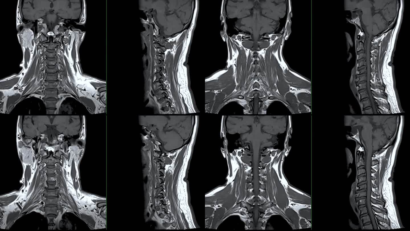 颈椎MRI或颈椎MRI冠状位和矢状位T2W片诊断颈椎病和压缩性骨折。