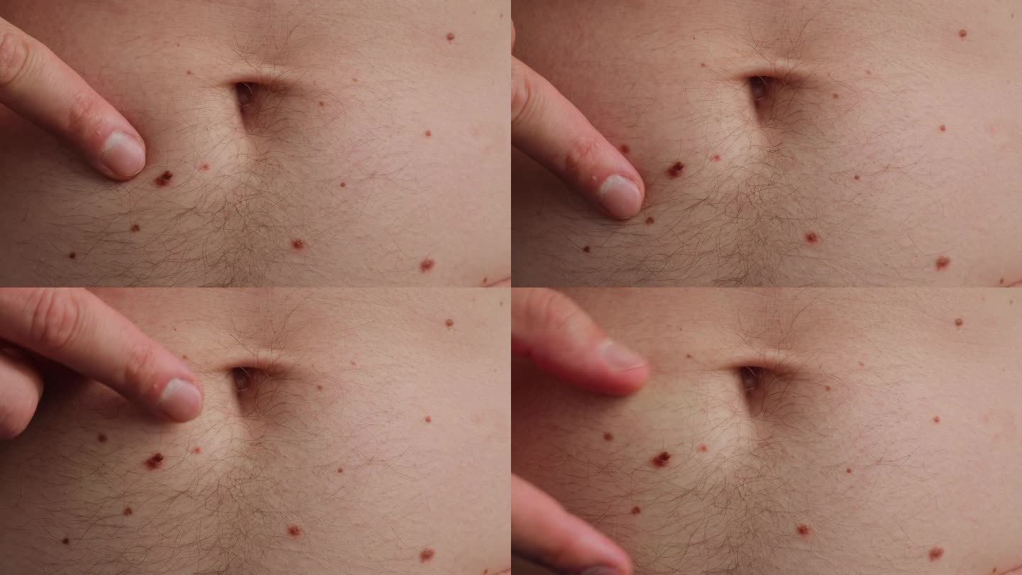 无法辨认的人在皮肤上显示他的胎记近距离细节裸露的皮肤阳光照射对皮肤的影响。紫外线辐射对男性胎记色素沉