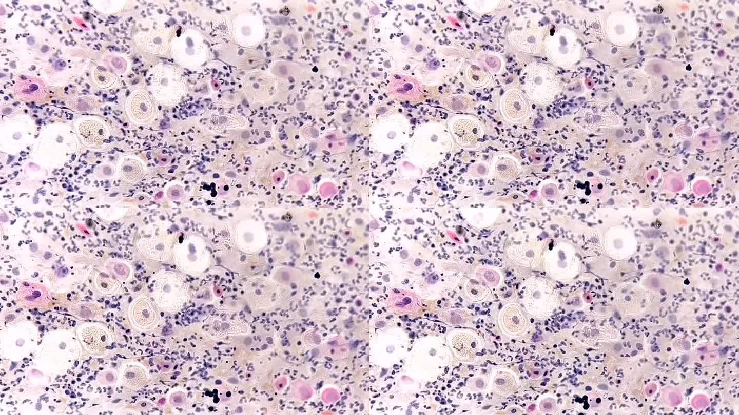巴氏涂片显微照片:阴道念珠菌感染的炎性涂片。医学概念。