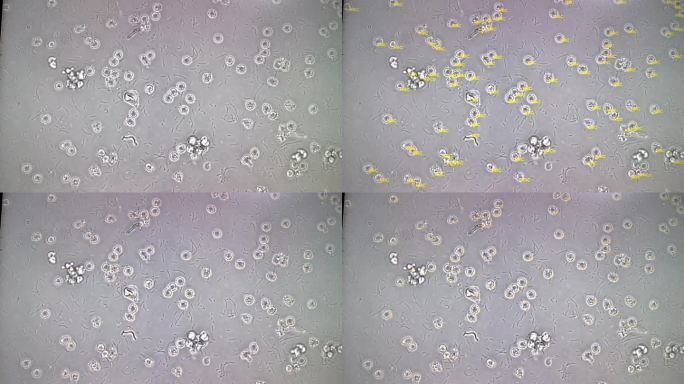 显微镜下尿液分析显示大量脓细胞，大量细菌和少量晶体和铸型。尿路感染。