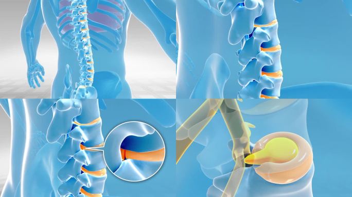 腰突三维机理 腰突髓核突出压迫神经