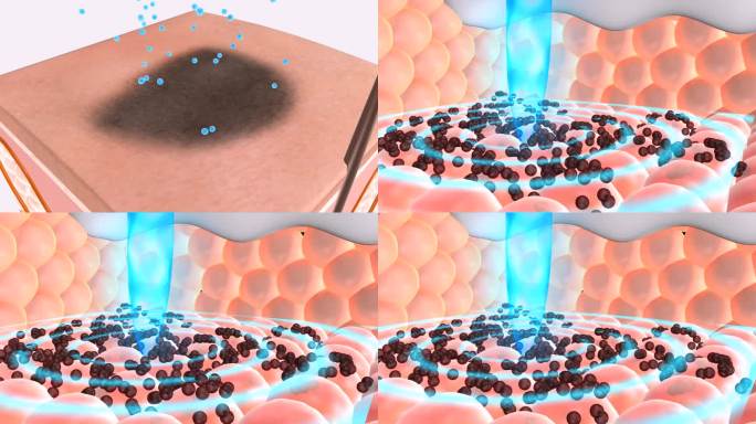 快速溶解皮肤深层的色素细胞色素细胞分离