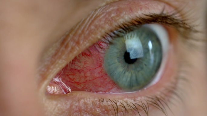 眼炎引起的充血性眼睛