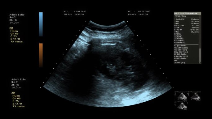 医用超声屏影像画面视频透视检查人体阴影