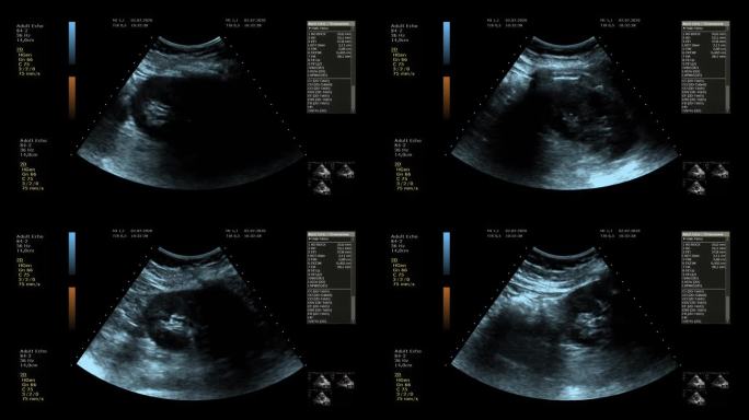 医用超声屏影像画面视频透视检查人体阴影