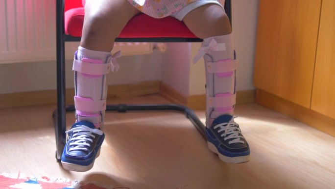 小儿脑瘫残疾，腿部矫形器。