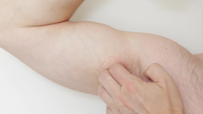 腋下皮疹、痤疮或红斑。不可识别的男子在使用剃刀、修剪器、除臭剂或止汗剂后，用手在敏感皮肤上抓伤刺激。