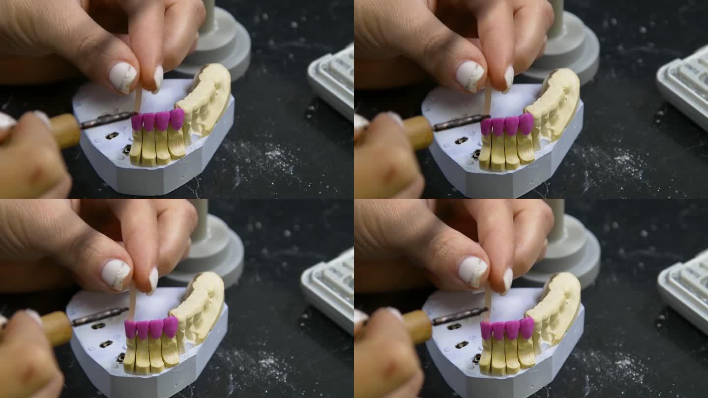 牙科技师使用牙冠和假牙的模具。牙科诊所中陶瓷假牙的制作。种植用陶瓷牙冠。