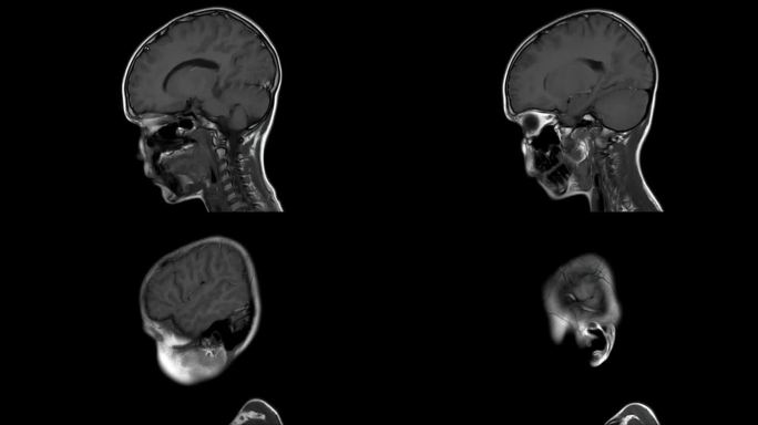 一个健康的10岁男孩的核磁共振脑部扫描——侧位图，环状图