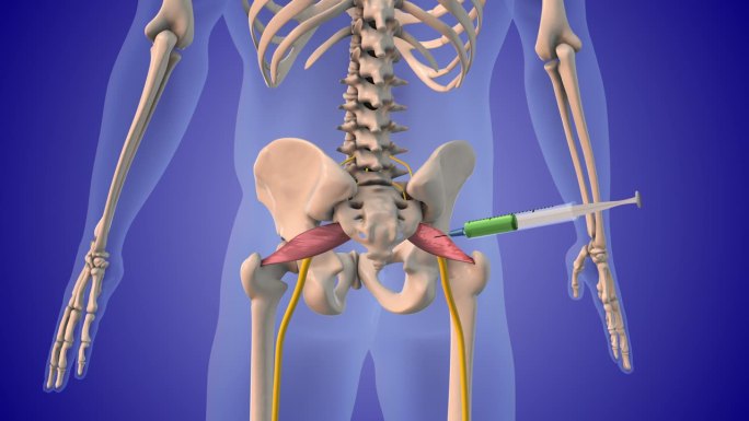 注射类固醇治疗梨状肌综合征