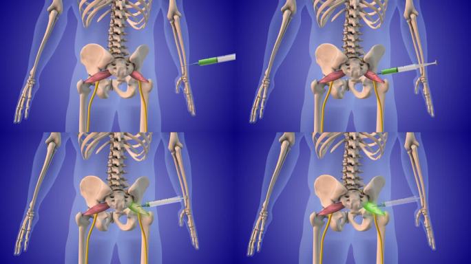 注射类固醇治疗梨状肌综合征