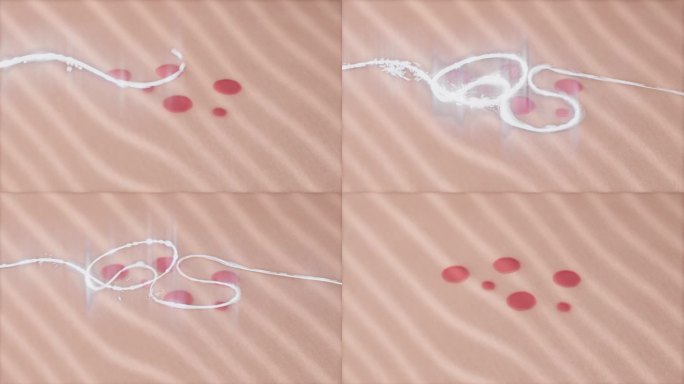 皮肤水处理。痤疮，粉刺，瑕疵愈合治疗- 3D动画渲染。