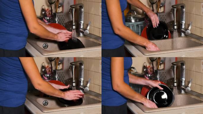 一个年轻女孩的白癜风疾病。脱色:皮肤部分的脱色一个女人在厨房的水槽里洗盘子。
