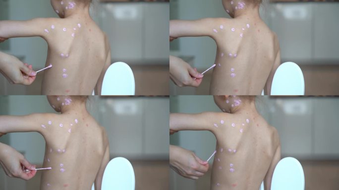 双手将药膏涂抹在患水痘的生病女孩的背上。皮疹治疗