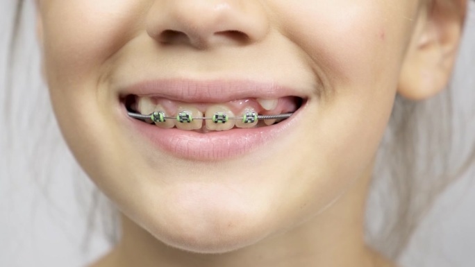 一个女孩戴着牙套炫耀她的牙齿。特写镜头。